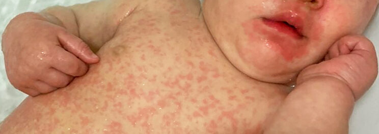 measles-manaia