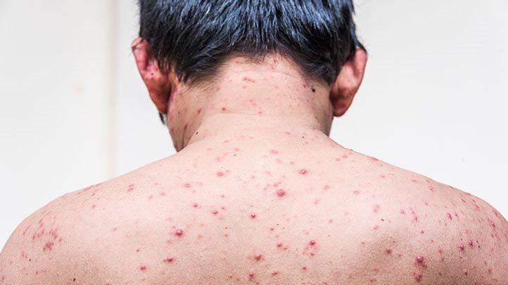 chickenpox-in-adults-722x406